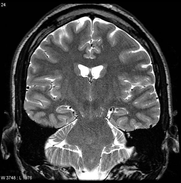 File:Normal coronal brain (Radiopaedia 6676-7910 Coronal T2 24).jpg