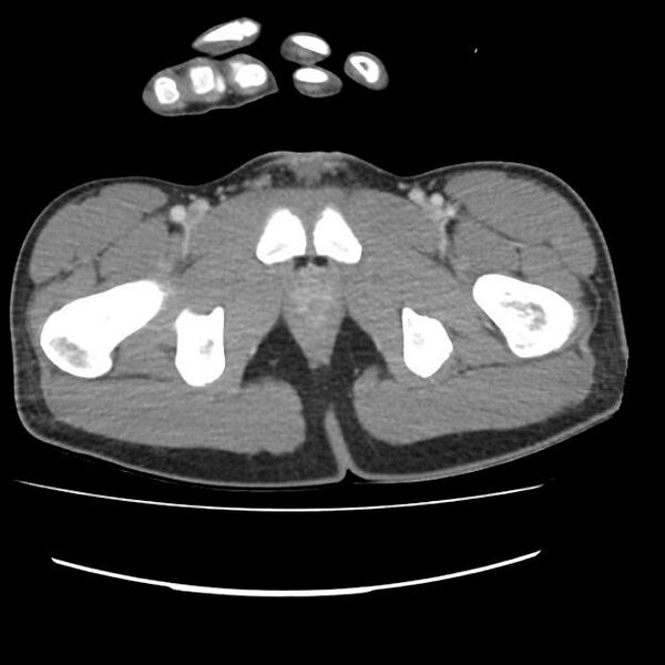 File:Normal dual-phase trauma CT chest,abdomen and pelvis (Radiopaedia 48092-52899 A 116).jpg