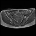 Normal female pelvis MRI (retroverted uterus) (Radiopaedia 61832-69933 Axial T1 13).jpg