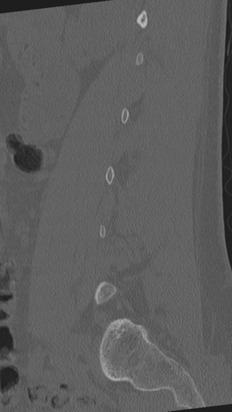 File:Normal lumbar spine CT (Radiopaedia 46533-50986 Sagittal bone window 73).png