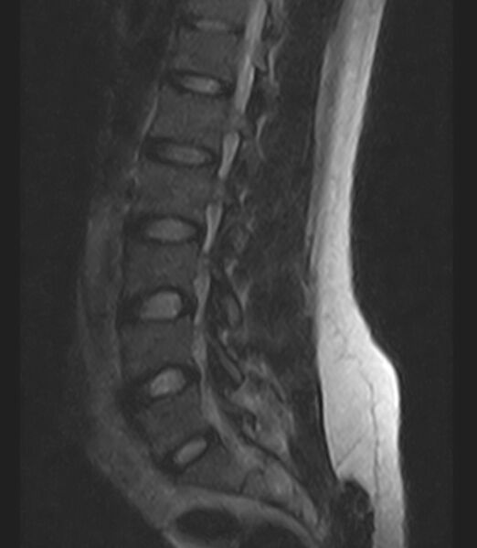 File:Normal lumbar spine MRI - low-field MRI scanner (Radiopaedia 40976-43699 Sagittal T2 8).jpg
