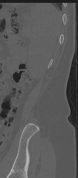 File:Normal lumbosacral CT (Radiopaedia 37923-39867 Sagittal bone window 2).png