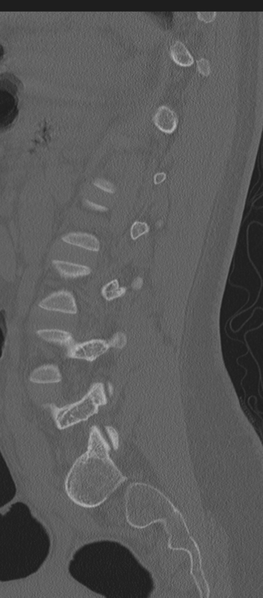 File:Normal lumbosacral CT (Radiopaedia 37923-39867 Sagittal bone window 34).png
