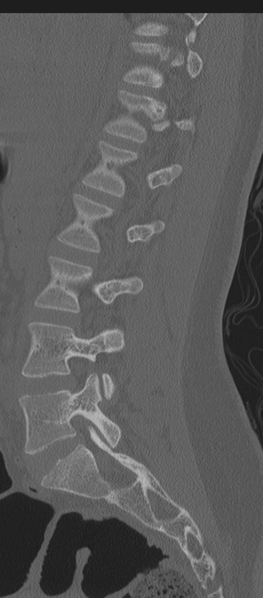 File:Normal lumbosacral CT (Radiopaedia 37923-39867 Sagittal bone window 61).png