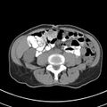 Normal multiphase CT liver (Radiopaedia 38026-39996 Axial non-contrast 50).jpg