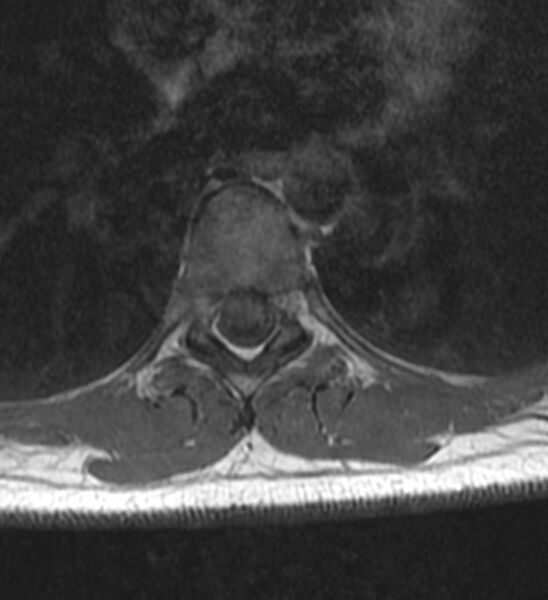File:Normal thoracic spine MRI (Radiopaedia 41033-43781 Axial T1 2).jpg