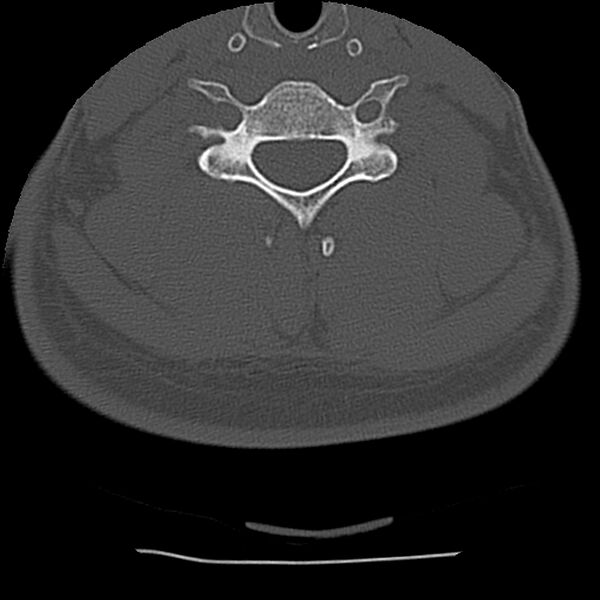File:Normal trauma spine imaging (Radiopaedia 31753-32686 Axial bone window 56).jpg