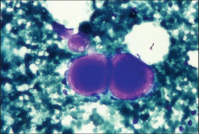 Cytological diagnosis of collagenous spherulosis of breast