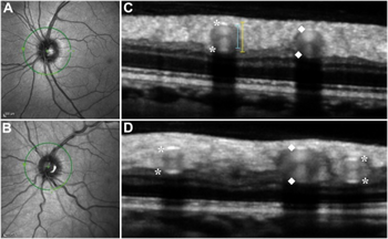 A–D Combined simultaneous confocal scanning laser ophthalmoscopy and spectral-domain optical coherence tomography
