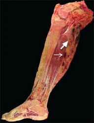 55-year-old female who initially presented with progressive right posterior calf pain now status post right leg amputation for malignant tenosynovial giant cell tumor. Gross pathology of the amputated right lower extremity reveals a heterogeneous tumor with cystic (thick arrow) and solid (thin arrow) components extending from the popliteal fossa to the mid-calf.