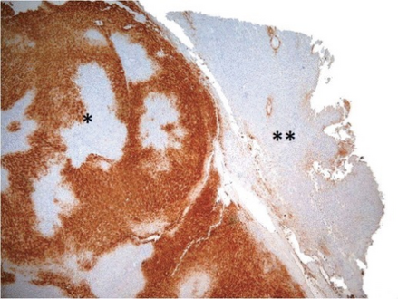Map-like pattern of staining of glutamine synthetase in FNH * as compared to normal liver **