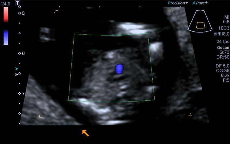 File:1st trimester nuchal-morphology ultrasound (Radiopaedia 44706-48477 Heart views cine with colour 141).jpg