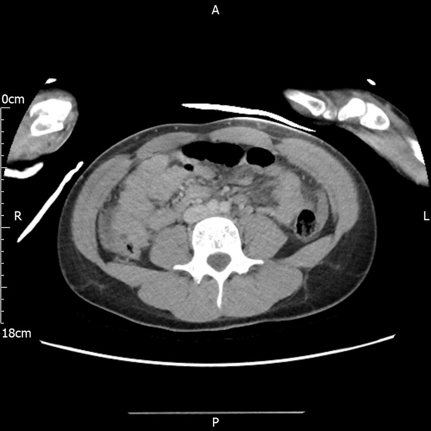 AAST grade IV kidney injury with CEUS follow-up (Radiopaedia 72353-82877 Axial C+ portal venous phase 41).jpg
