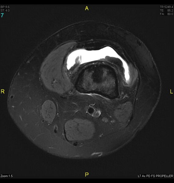 File:ACL mucoid degeration with cystic changes (Radiopaedia 48428-53341 Axial PD fat sat 4).jpg