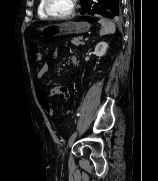 File:Abdominal aortic aneurysm (Radiopaedia 25855-26001 Sagittal C+ arterial phase 50).jpg