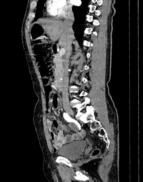 File:Abdominal aortic aneurysm (Radiopaedia 83581-98689 Sagittal C+ arterial phase 26).jpg