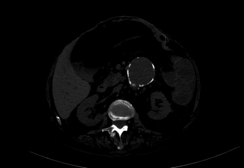 File:Abdominal aortic aneurysm - impending rupture (Radiopaedia 19233-19246 B 5).jpg