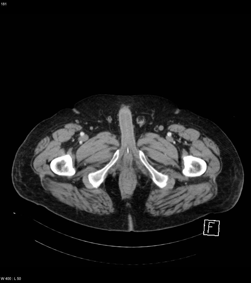 Abdominal aortic aneurysm with intramural hematoma then rupture (Radiopaedia 50278-55632 Axial C+ arterial phase 180).jpg