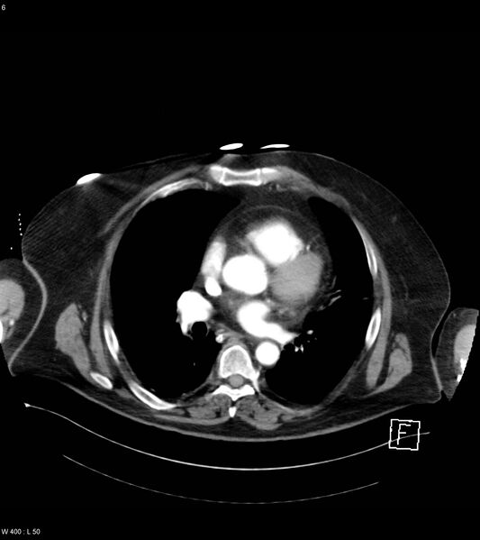 File:Abdominal aortic aneurysm with intramural hematoma then rupture (Radiopaedia 50278-55632 Axial C+ arterial phase 5).jpg