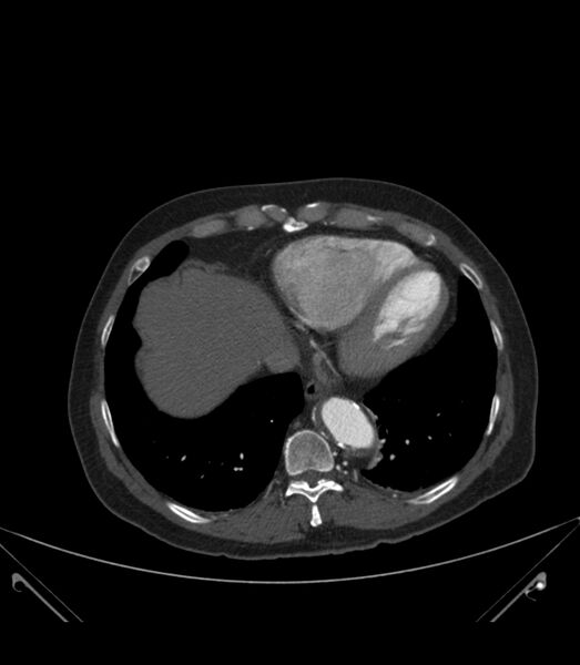 File:Abdominal aortic aneurysm with thrombus fissuration (Radiopaedia 46218-50618 Axial C+ arterial phase 3).jpg