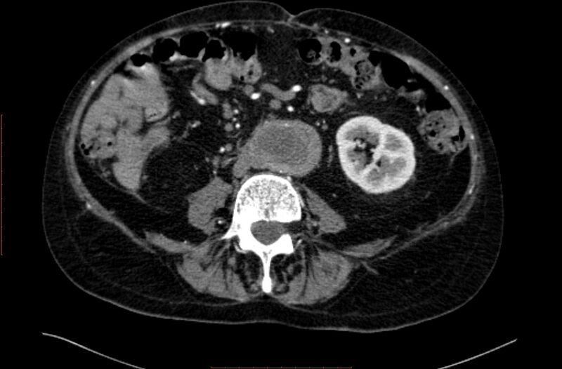 File:Abdominal aortic interposition tube graft and aneurysm thrombosis (Radiopaedia 71438-81857 Axial C+ arterial phase 100).jpg