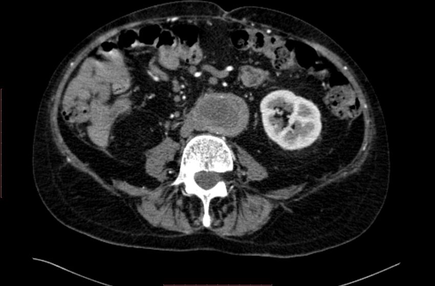 Abdominal aortic interposition tube graft and aneurysm thrombosis (Radiopaedia 71438-81857 Axial C+ arterial phase 100).jpg