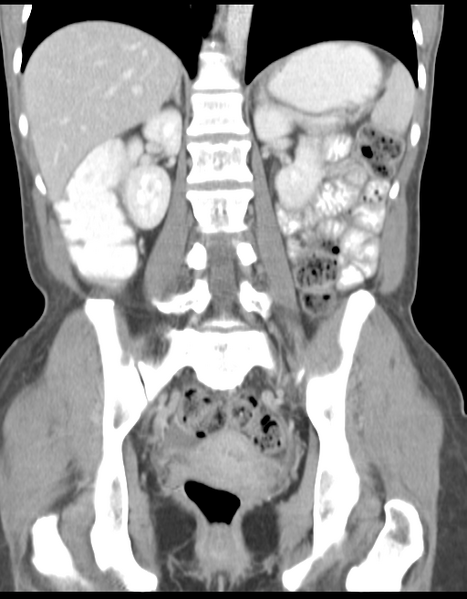 File:Abdominal desmoid tumor (Radiopaedia 41007-43740 Coronal C+ portal venous phase 26).png