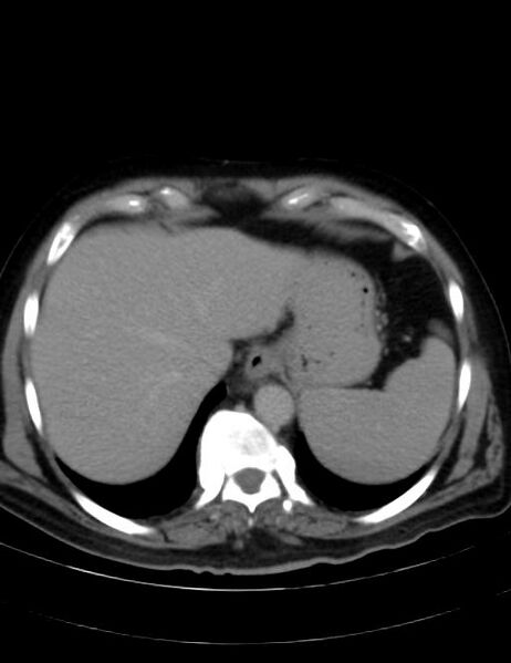 File:Abdominal lymphoma - with sandwich sign (Radiopaedia 53486-59492 Axial C+ portal venous phase 7).jpg
