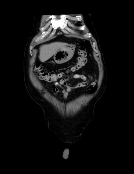 File:Abdominal lymphoma - with sandwich sign (Radiopaedia 53486-59492 C+ portal venous phase 51).jpg