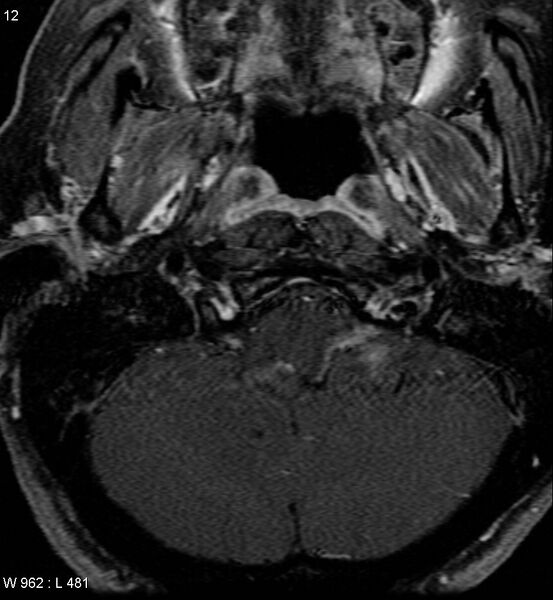 File:Acoustic schwannoma (large with cystic change) (Radiopaedia 5369-7130 Axial T1 C+ fat sat 10).jpg