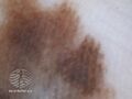 Acral lentiginous melanoma dermoscopy (DermNet NZ alm-dermoscopy-2).jpg