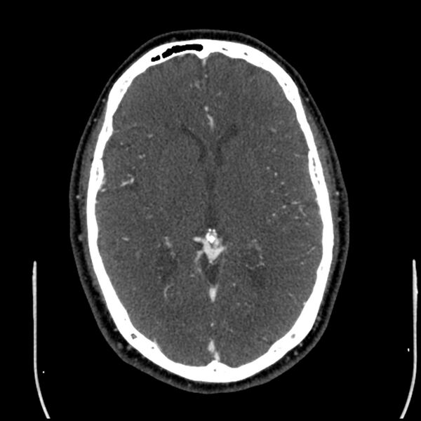 File:Acute A3 occlusion with ACA ischemic penumbra (CT perfusion) (Radiopaedia 72036-82527 Axial C+ arterial phase thins 71).jpg