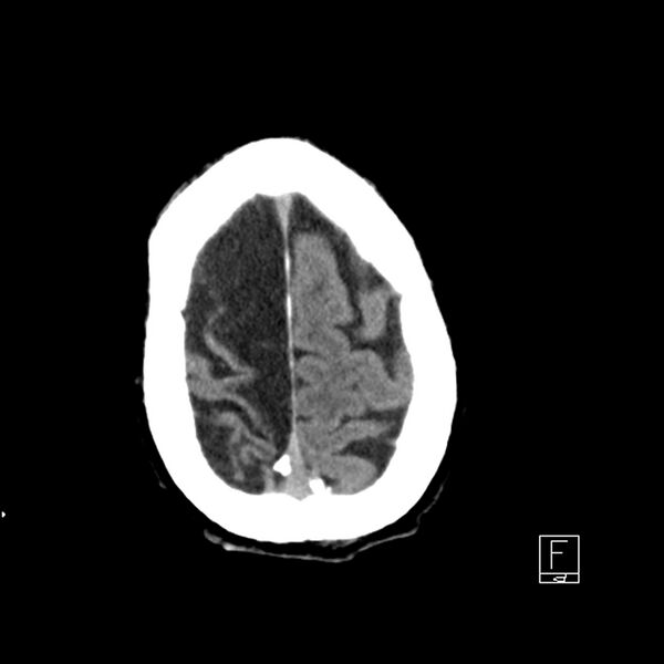File:Acute ICA ischemic penumbra due to high-grade CCA stenosis (CT perfusion) (Radiopaedia 72038-82529 Axial non-contrast 42).jpg