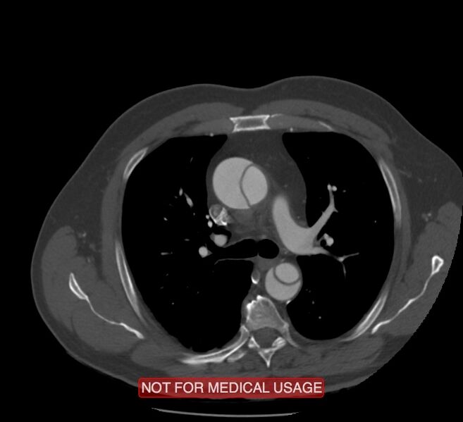 File:Acute aortic dissection - Stanford type A (Radiopaedia 40661-43285 Axial C+ arterial phase 18).jpg