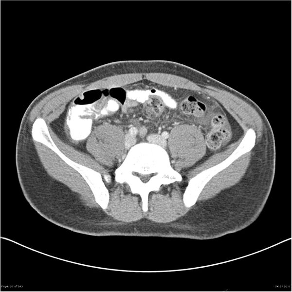 File:Acute appendicitis (Radiopaedia 25364-25615 B 47).jpg
