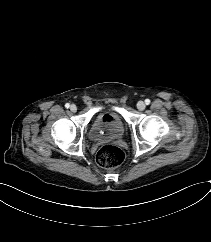 Acute arterial mesenteric ischemia (Radiopaedia 78238-90828 Axial C+ portal venous phase 134).jpg