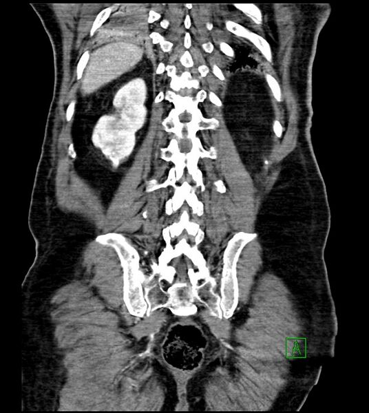 File:Acute arterial mesenteric ischemia (Radiopaedia 78238-90828 Coronal C+ portal venous phase 73).jpg