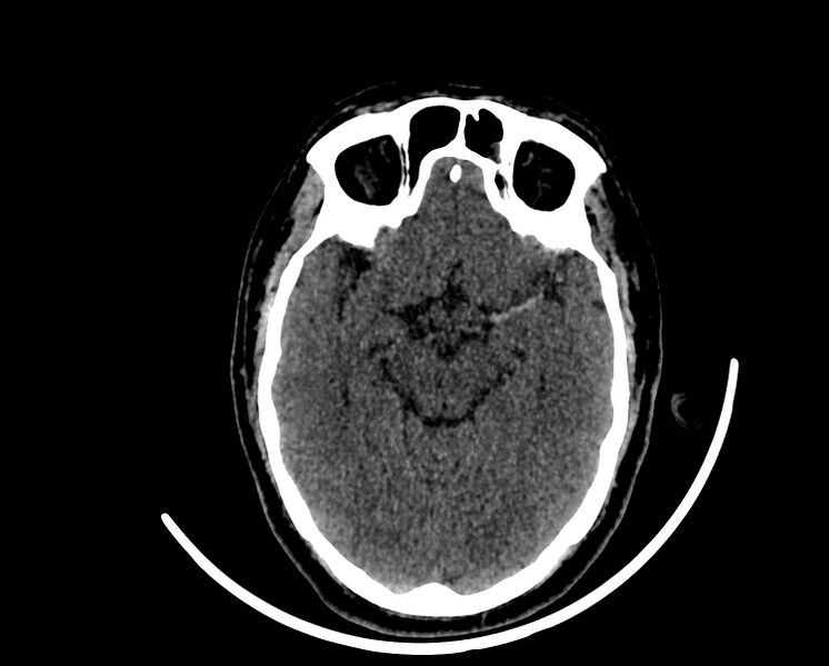 File:Acute cerebral infarct (Radiopaedia 35604-37123 Hyperdense MCA sign 1).jpg