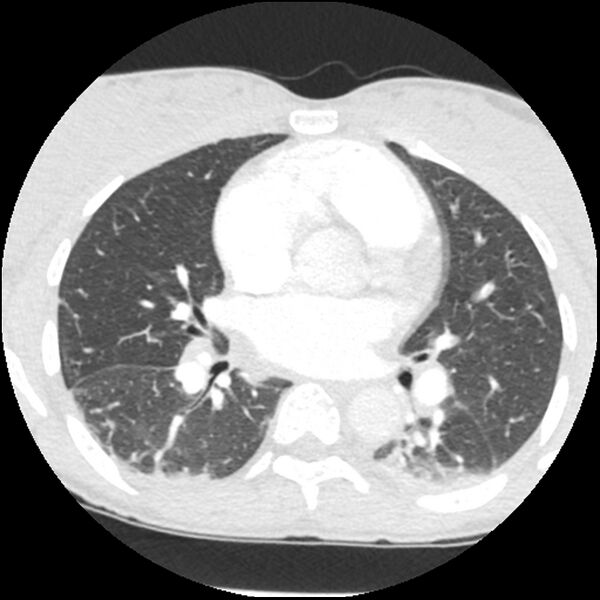 File:Acute chest syndrome - sickle cell disease (Radiopaedia 42375-45499 Axial lung window 99).jpg