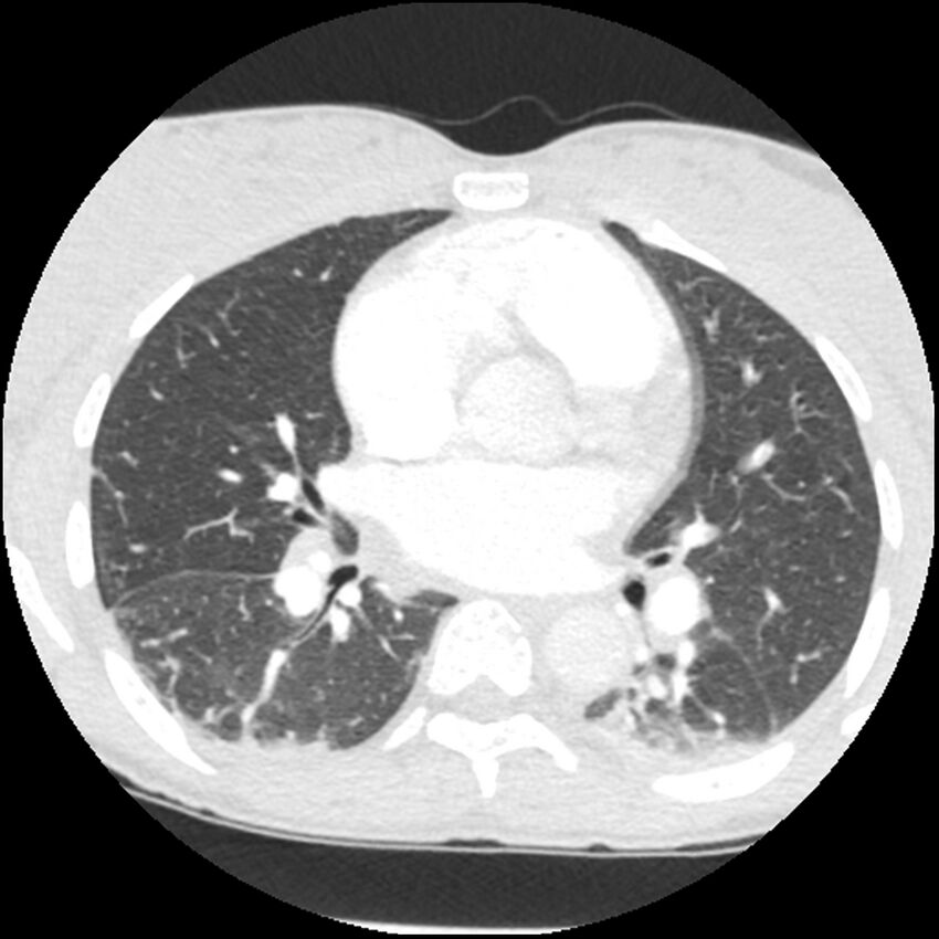 Acute chest syndrome - sickle cell disease (Radiopaedia 42375-45499 Axial lung window 99).jpg
