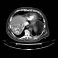 Acute heart failure (CT) (Radiopaedia 79835-93075 Axial C+ arterial phase 56).jpg