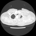 Acute heart failure (CT) (Radiopaedia 79835-93075 Axial lung window 4).png