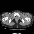 Acute myocarditis (Radiopaedia 55988-62613 Axial C+ portal venous phase 83).jpg