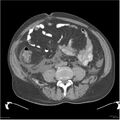 Acute pancreatitis (Radiopaedia 19135-19116 Axial non-contrast 37).jpg