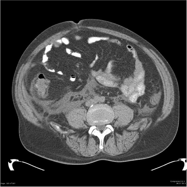 File:Acute pancreatitis (Radiopaedia 19135-19116 Axial non-contrast 37).jpg