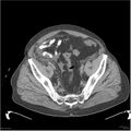 Acute pancreatitis (Radiopaedia 19135-19116 Axial non-contrast 50).jpg