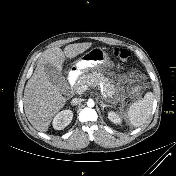 File:Acute pancreatitis (Radiopaedia 23231-23290 Axial C+ arterial phase 34).JPG