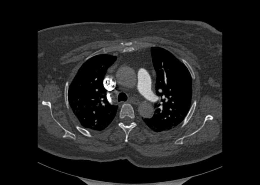 Acute pulmonary embolism (Radiopaedia 29938-30466 Axial C+ CTPA 17).jpg