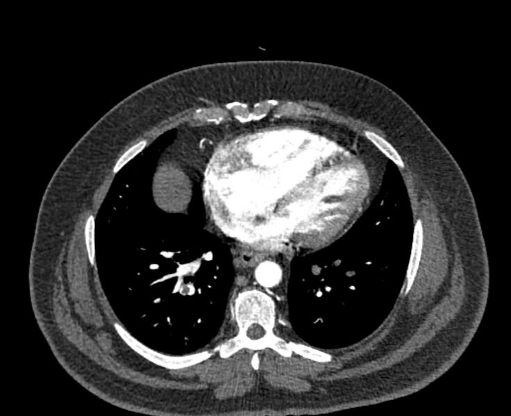 File:Acute pulmonary embolism with pulmonary infarcts (Radiopaedia 77688-89908 Axial C+ CTPA 44).jpg