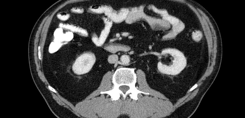 Acute sigmoid colon diverticulitis (Radiopaedia 55507-61976 Axial C+ portal venous phase 5).jpg